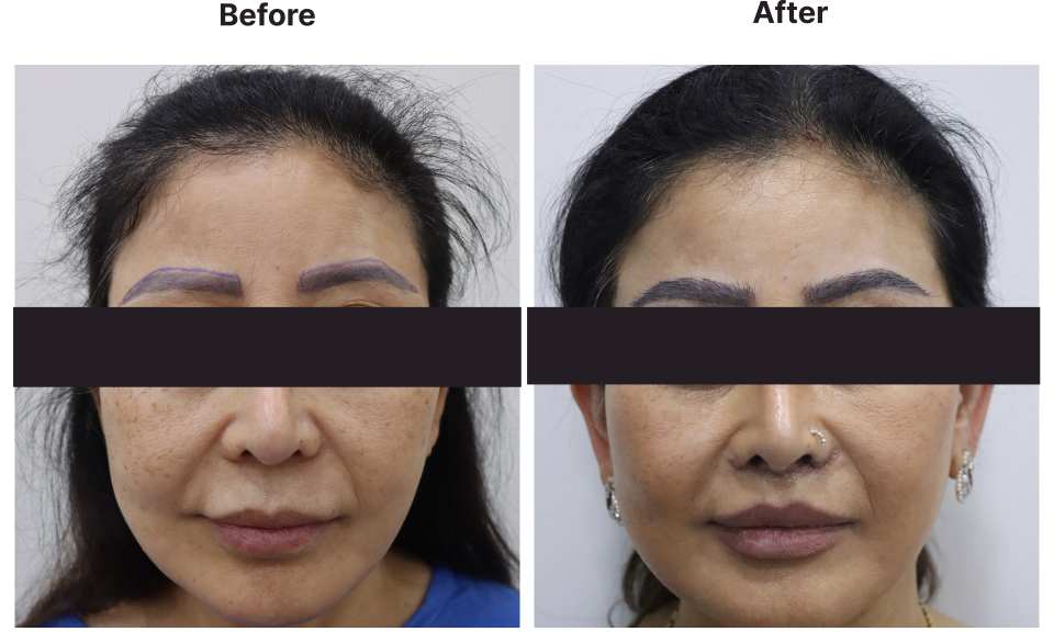 Hair Transplant result KOQ10